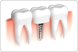 A diagram of a dental implant