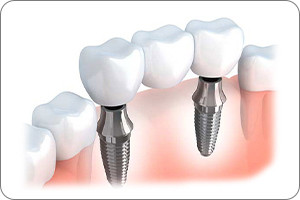 A diagram of dental implants