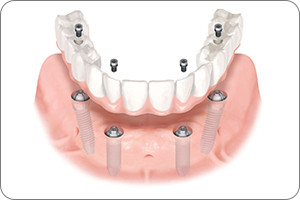A diagram of dental implants