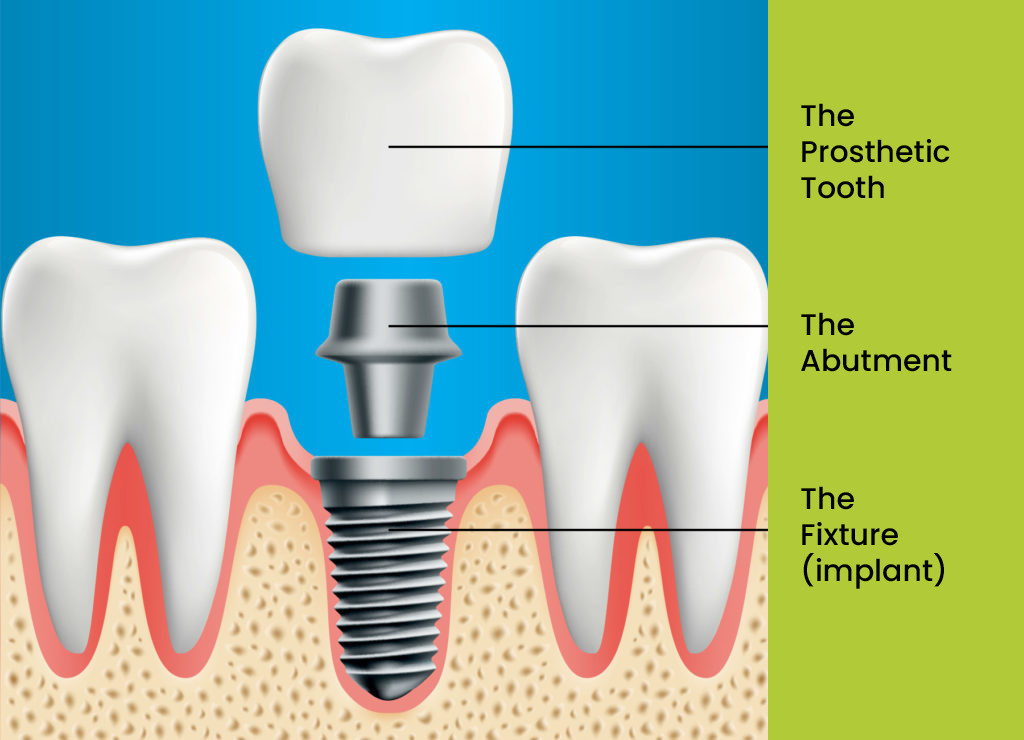 A diagram of a tooth implant